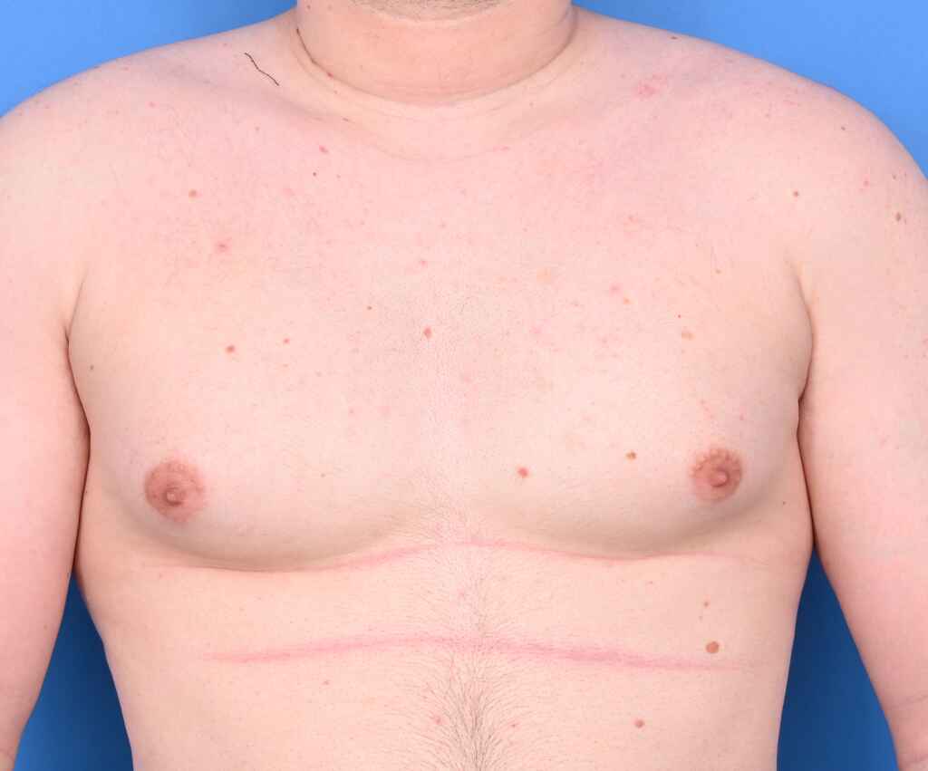 What You Need to Know About Gynecomastia and Good Posture