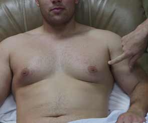 Male Breast Reduction Surgery model