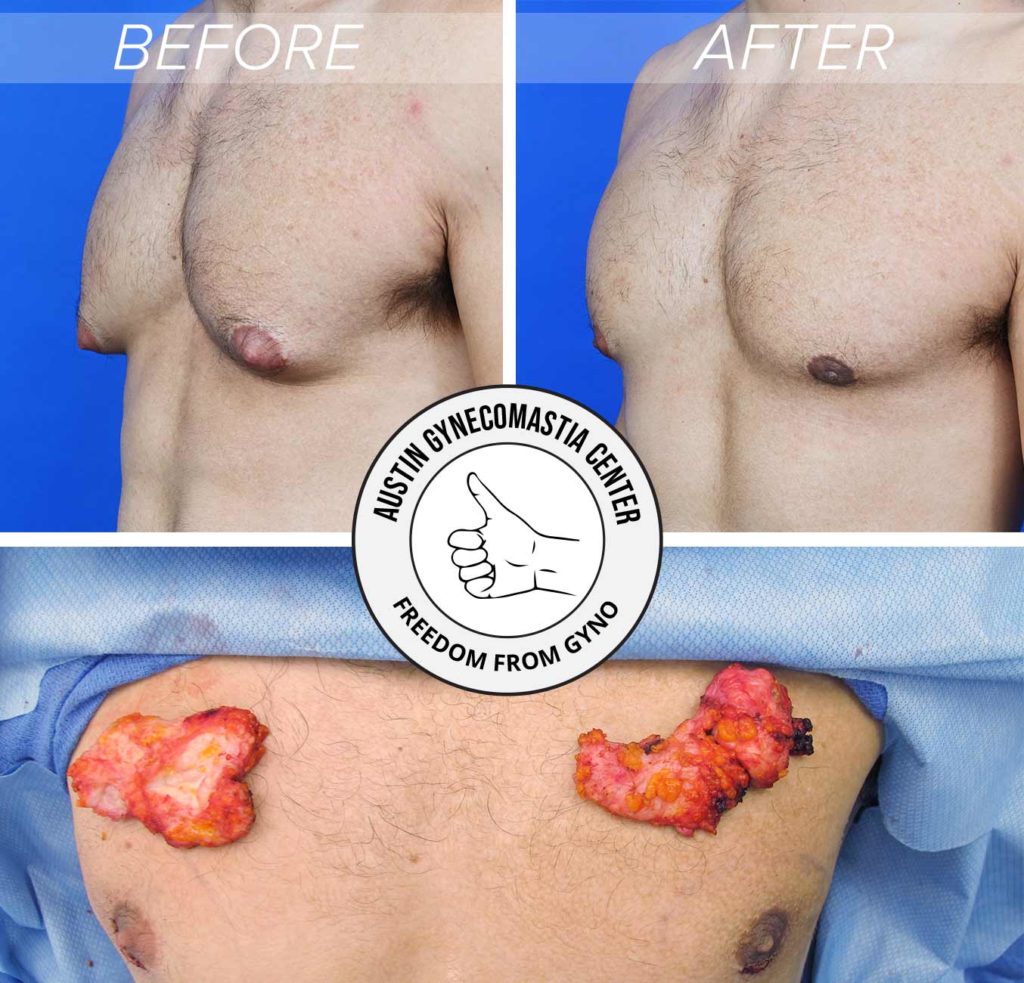 before and after Gynecomastia surgery including surgery showing Gynecomastia gland removed