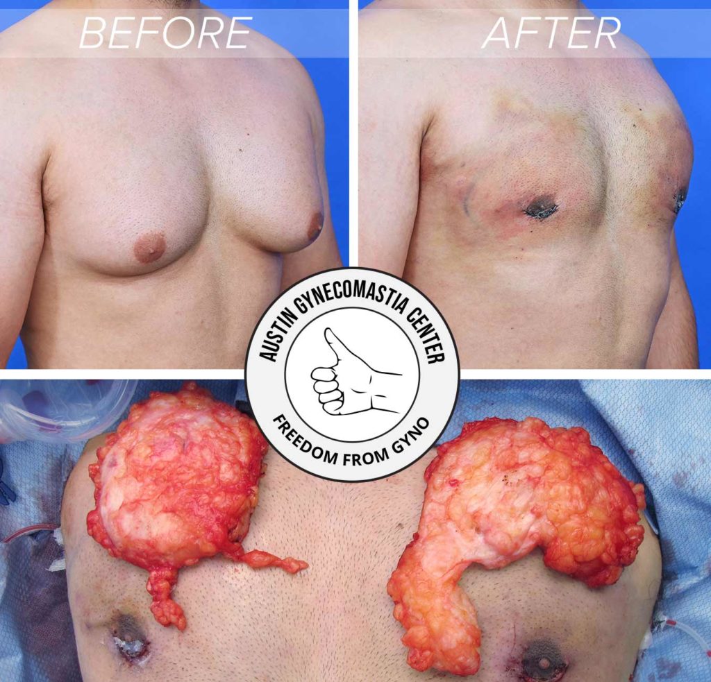 before and after gynecomastia surgery including gland removed during surgery