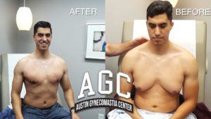 90 Minutes Of Gynecomastia Surgery - Your Questions Answered