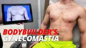 Bodybuilder treated at the austin gynecomastia center