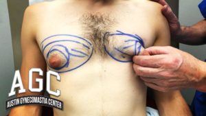 How To Get Rid Of Chest Fat - Before and After Gynecomastia