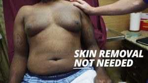 Man examined for skin removal