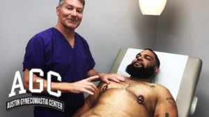 gynecomastia surgery patient update who had skin excision gynecomastia removal with free nipple graft