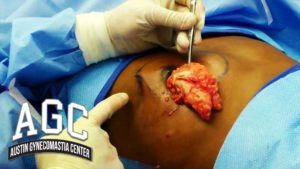 Tissue removed from gynecomastia surgery patient
