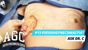 What Is Pseudogynecomastia? Do I have chest fat or Gynecomastia? Ask Dr. C - Episode 13