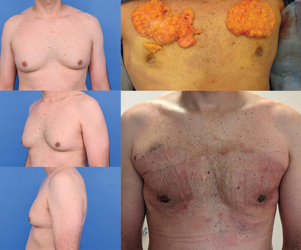 A Quick Reminder of What We Do at the Austin Gynecomastia Center
