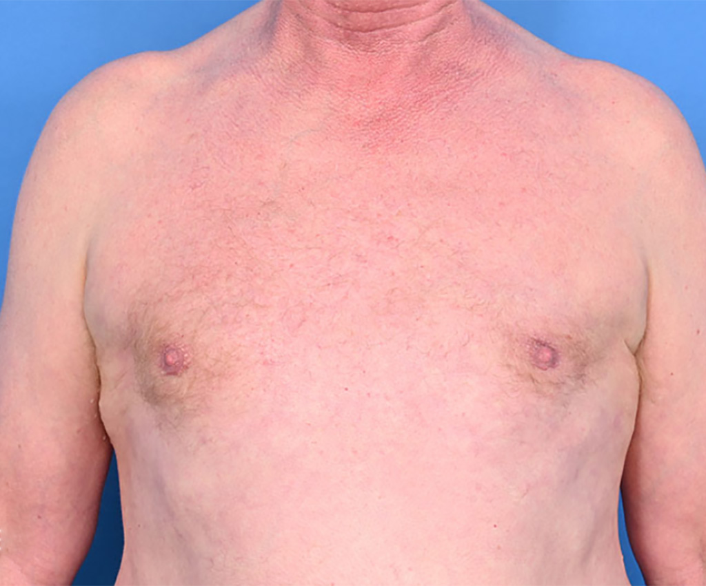 What Is Gynecomastia? Understanding This Common but Overlooked Condition in Men
