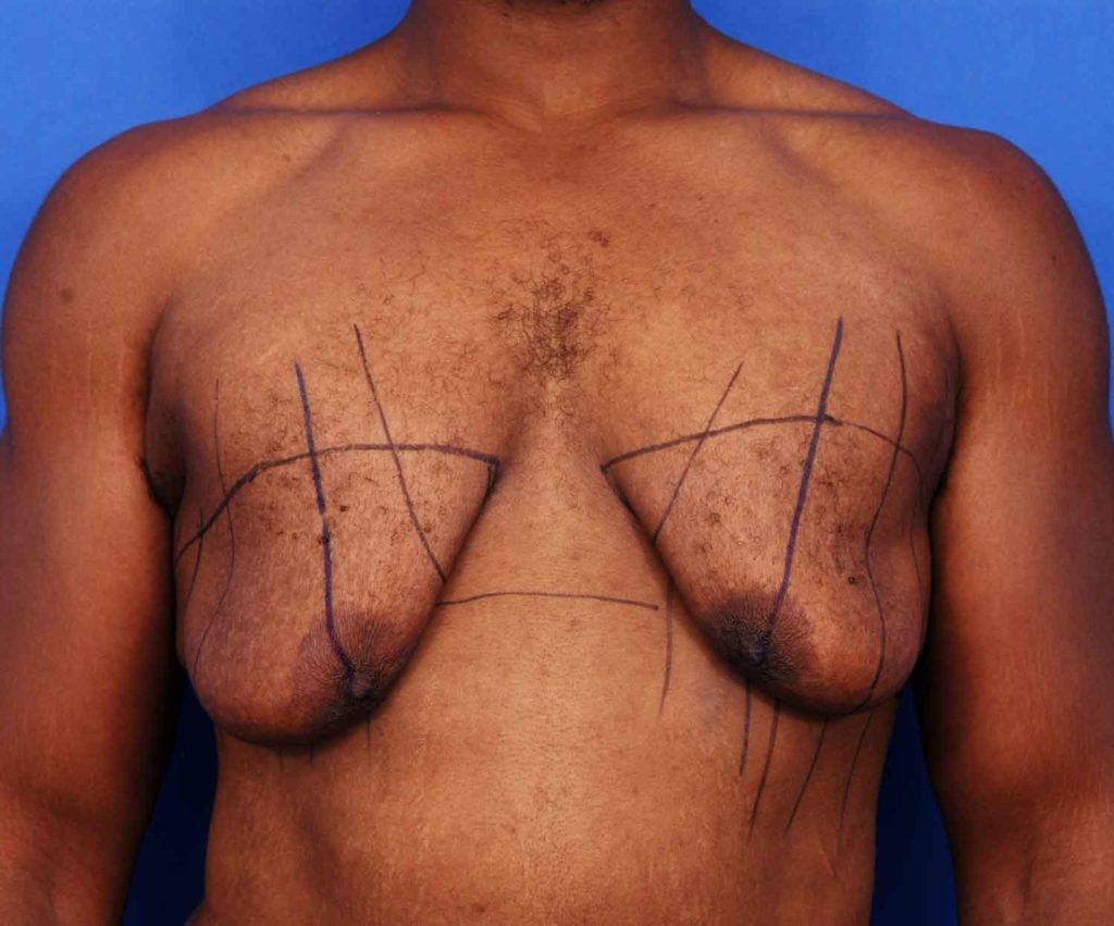 Male patient with loose chest tissue