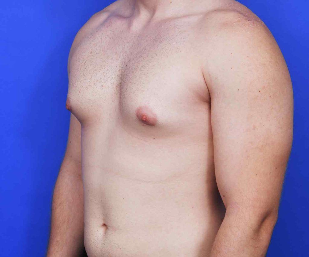 Male patient with signs of gynecomastia
