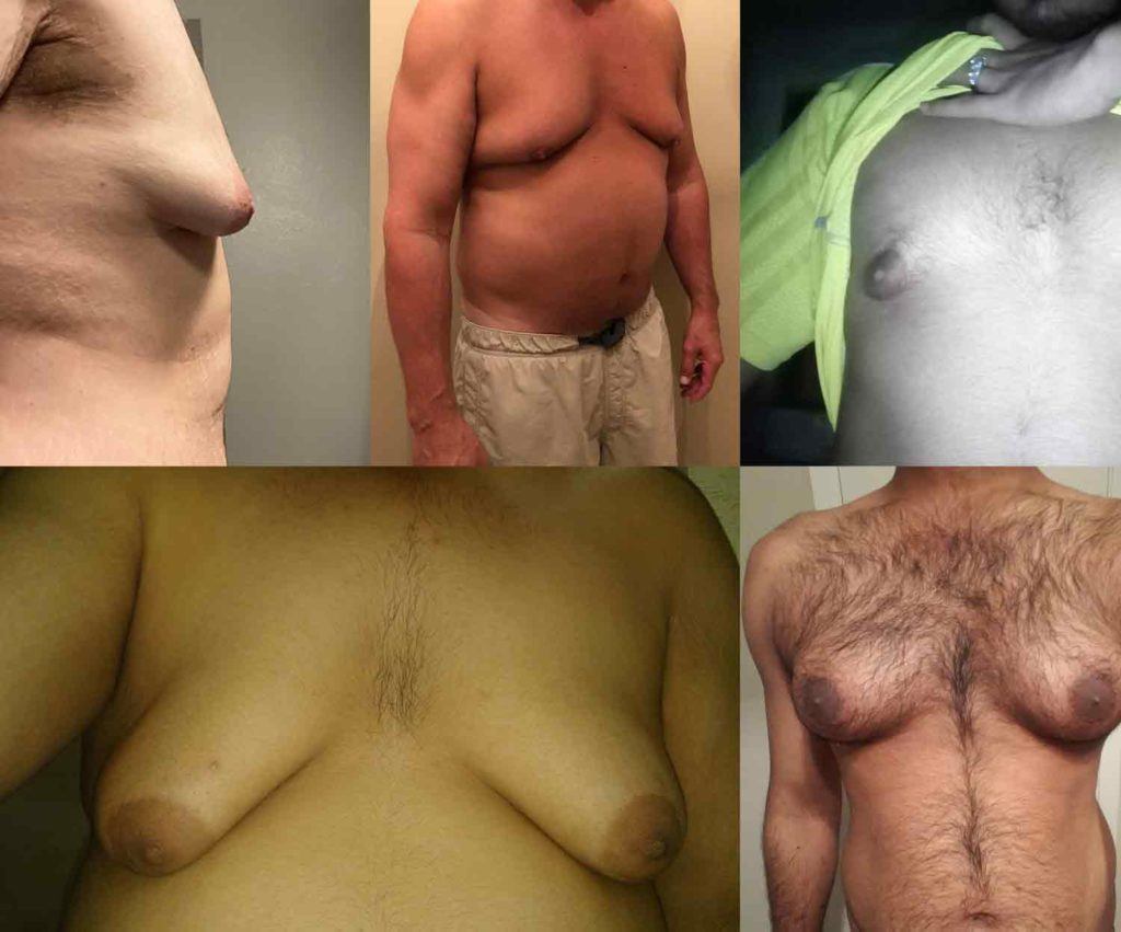 Chest shots of five men with potential gynecomastia