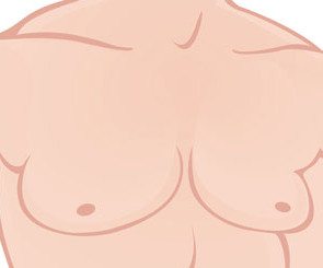 gynecomastia illustration