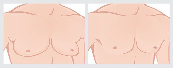 gynecomastia illustration