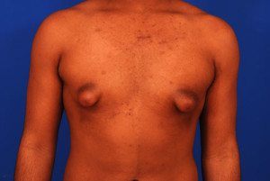 Gynecomastia and Tubular Breast Condition on man