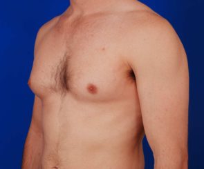 Example of male chest with gynecomastia