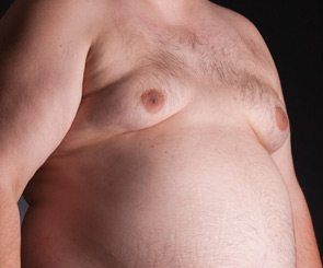 gynecomastia in obese patients