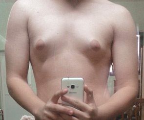 Gynecomastia surgery candidate taking a picture