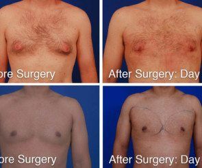 Results after gynecomastia surgery