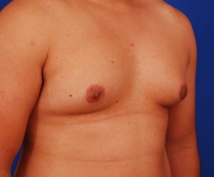 Chest of male gynecomastia patient