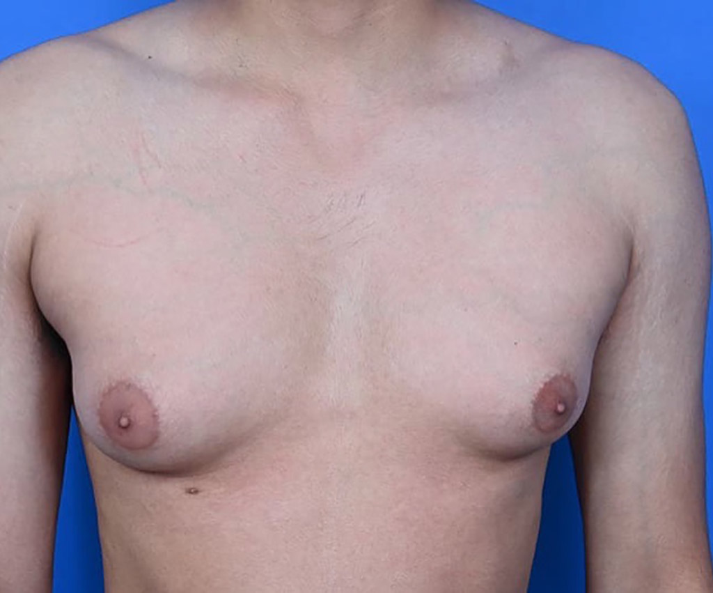 a patient with puffy nipples