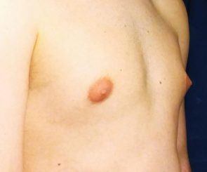 Male chest with puffy nipples