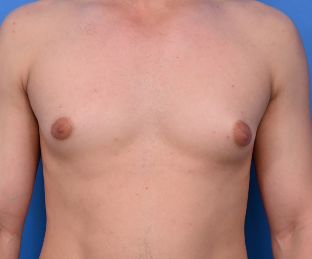 Why Does My Gynecomastia Look Better When It's Cold?