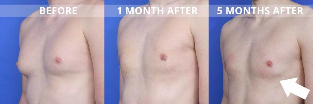 before and after showing scar tissue development after gynecomastia surgery
