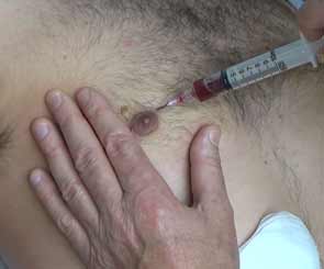 Syringe injected in male breast