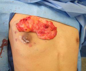 one sided unilateral gynecomastia tissue removed