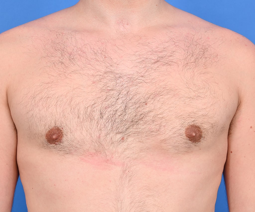 What You Need to Know About Revision Gynecomastia and What I Learned Recently