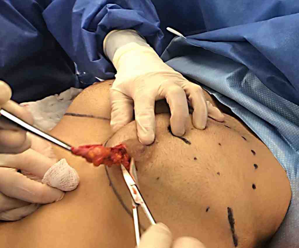 why do we get Gynecomastia surgery