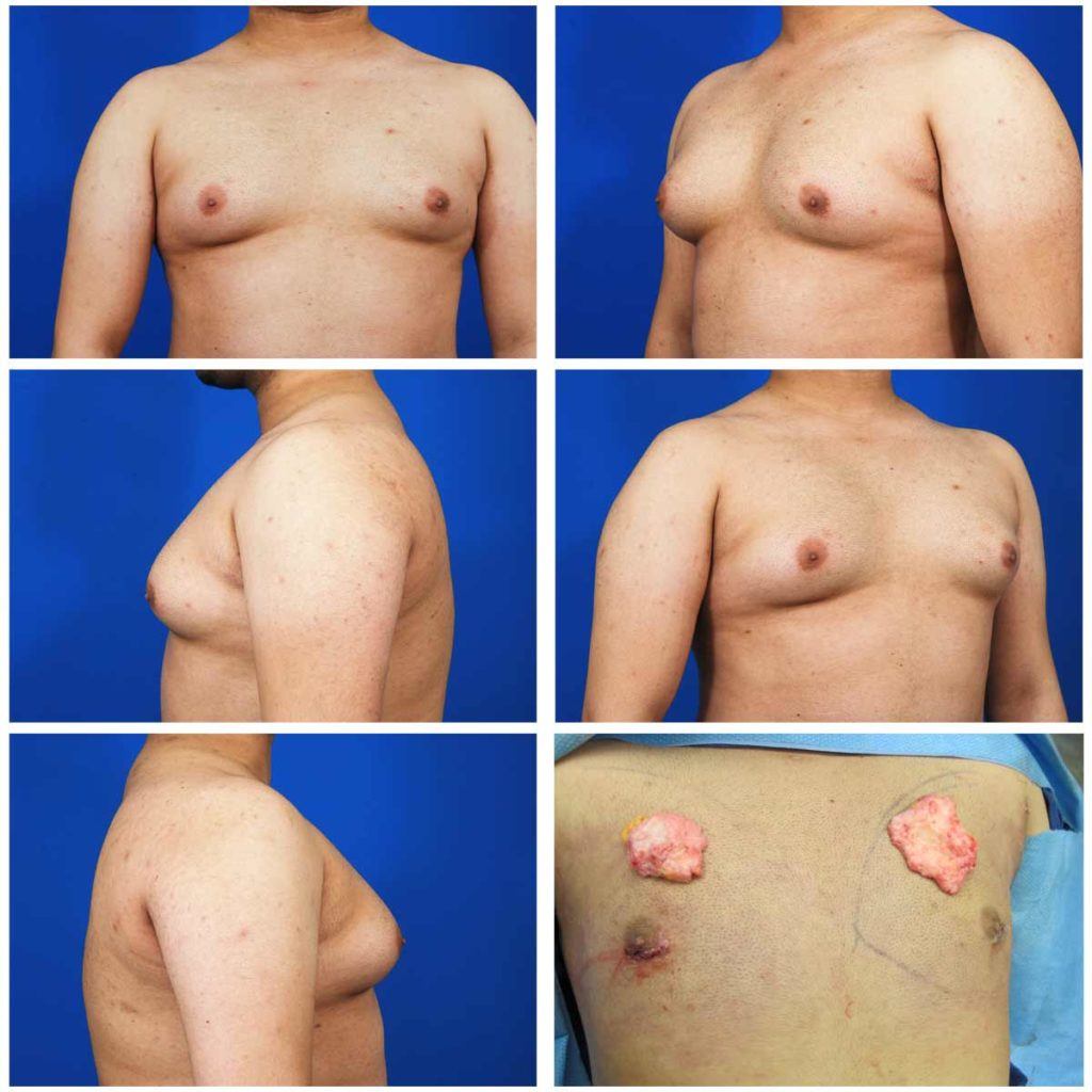 grid of before gynecomastia surgery images showing why get your gynecomastia treated
