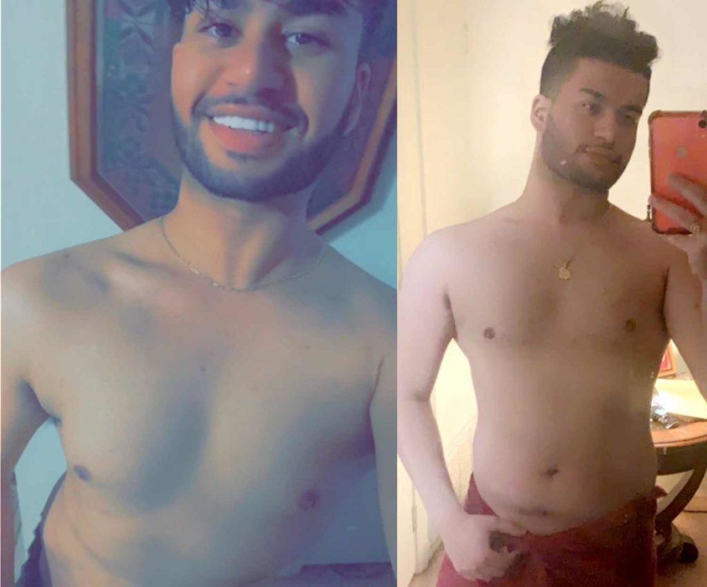 Gynecomastia patient before and after