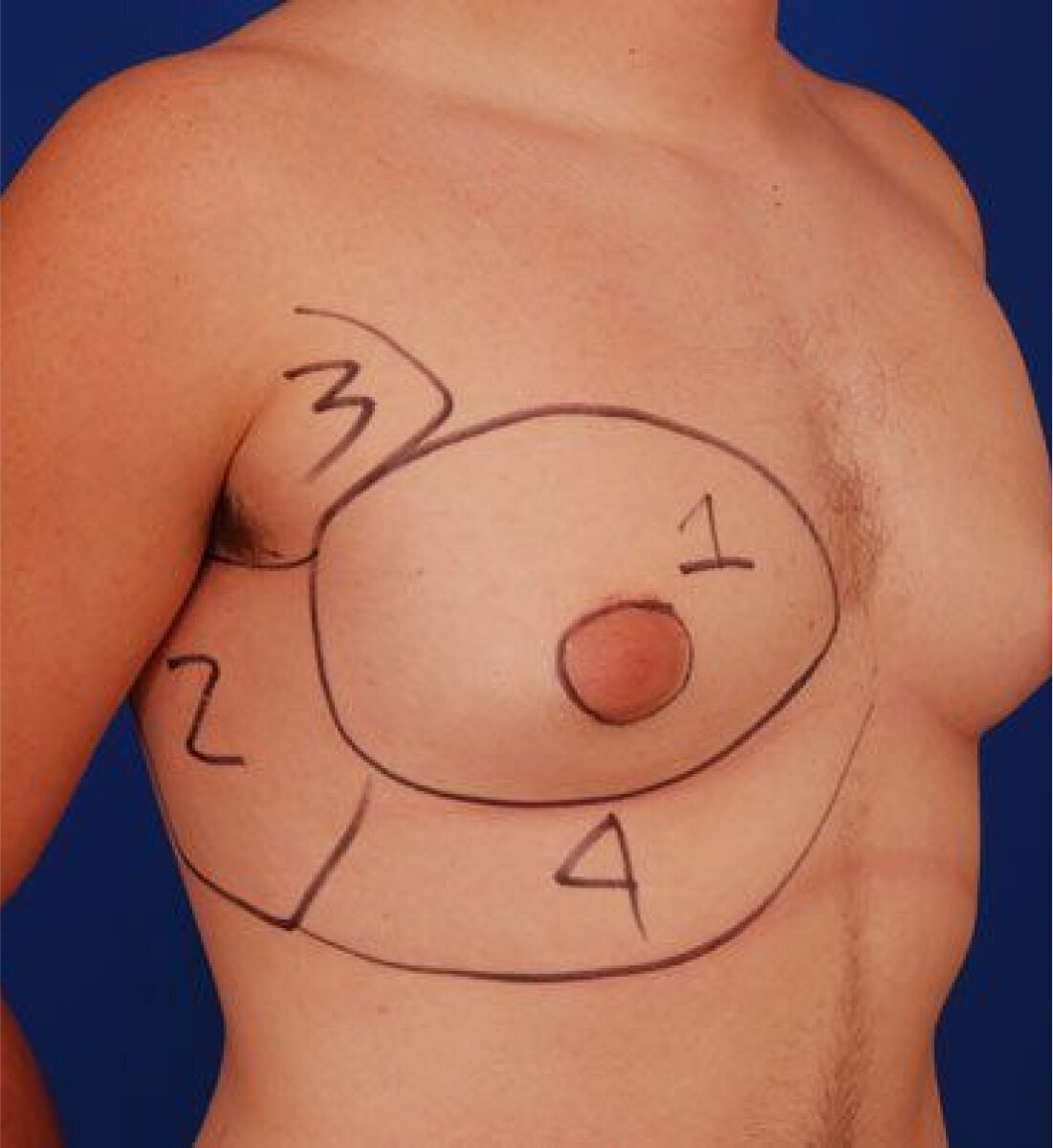 gynecomastia patient with surgical markings