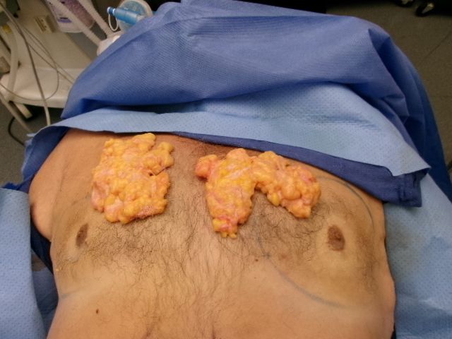 Gynecomastia patient results