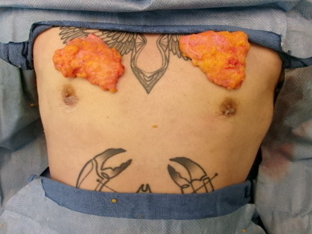 Gynecomastia patient results