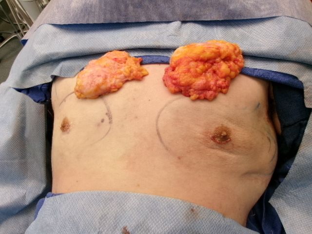 Gynecomastia patient results