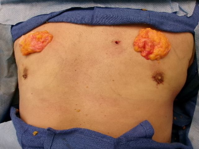 Gynecomastia patient results