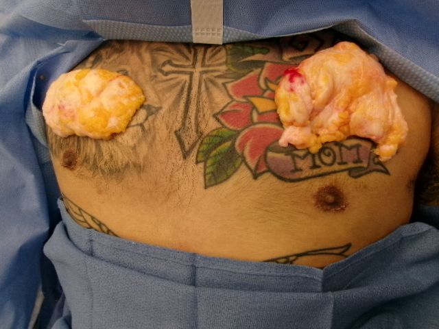 Gynecomastia patient results