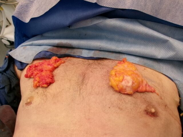 Gynecomastia patient results