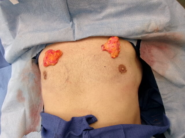 Gynecomastia tissue removed during this patient’s surgery