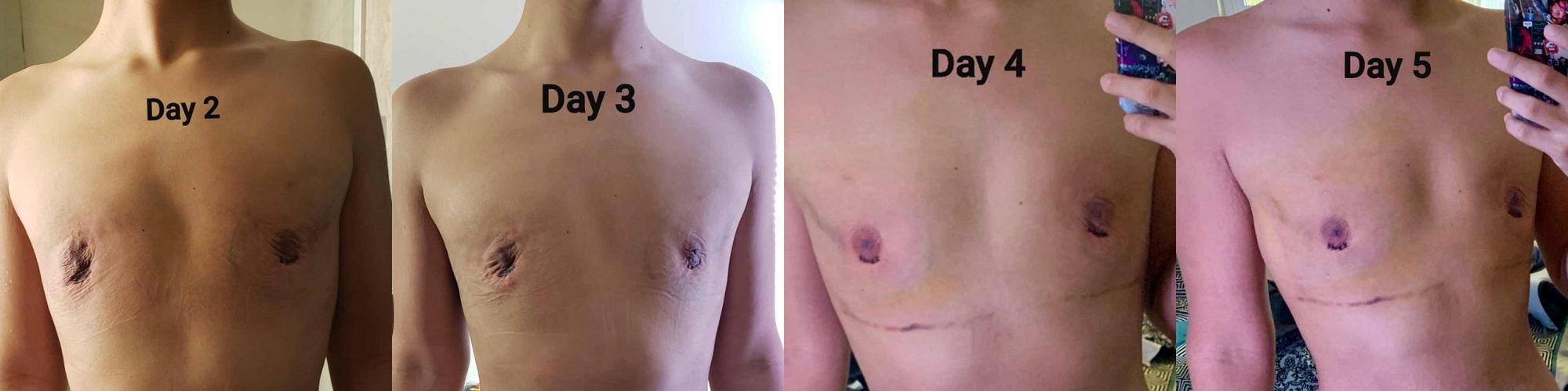 Male after 4 days after gynecomastia surgery