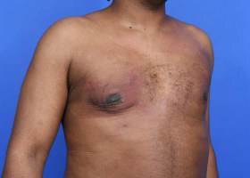 Gynecomastia Surgery patient After 