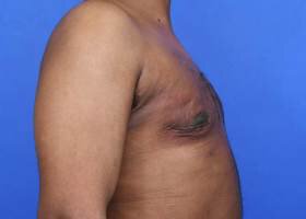 Gynecomastia Surgery patient After