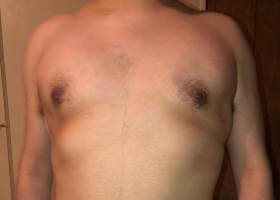 After Gynecomastia Surgery patient