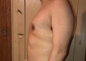 After Gynecomastia Surgery patient