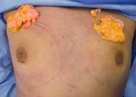 Glands removed during surgery of male breast reduction