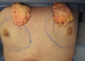 Glands removed during Gynecomastia surgery