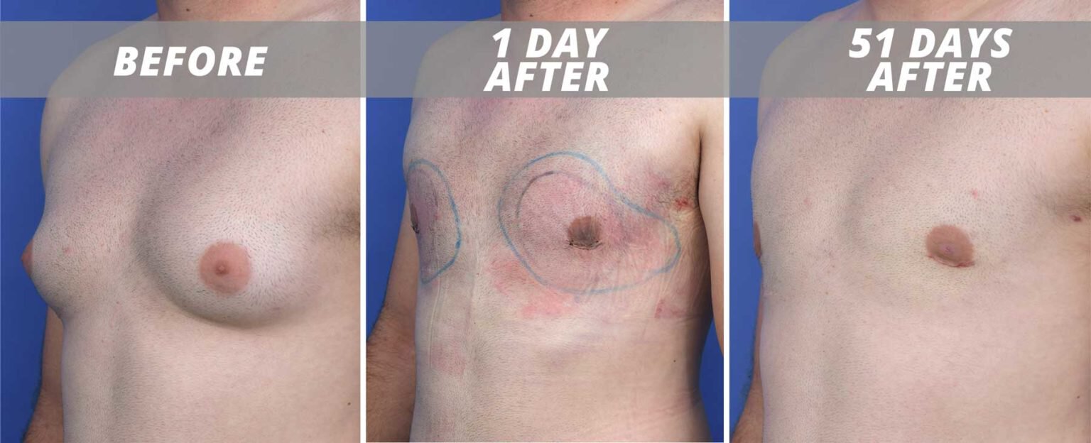 Before and after gynecomastia surgery